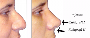 Zuñigraft I y II